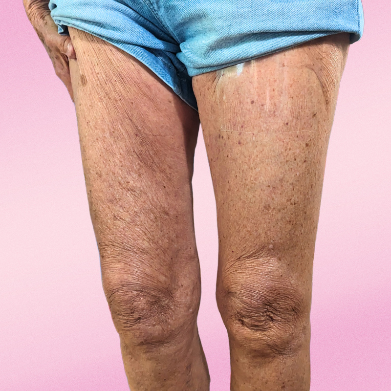 SmoothLyft™ Skin Strips