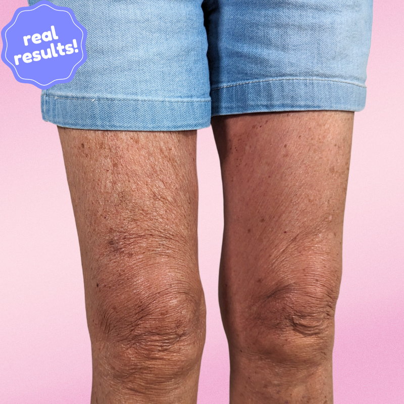 SmoothLyft™ Skin Strips
