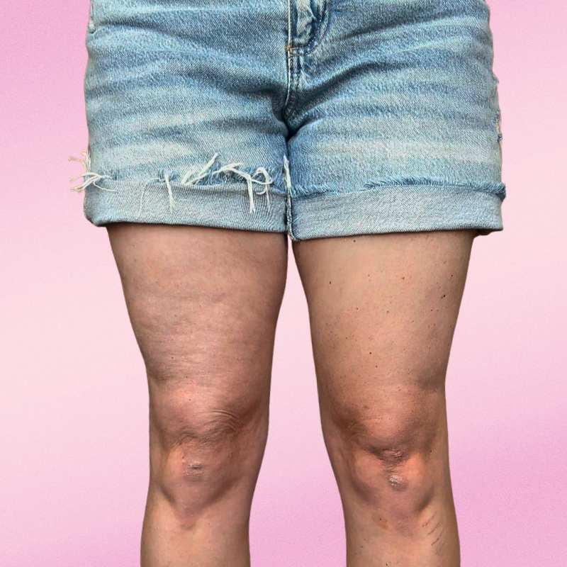 SmoothLyft™ Skin Strips